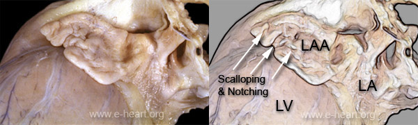 Left atrial appendage